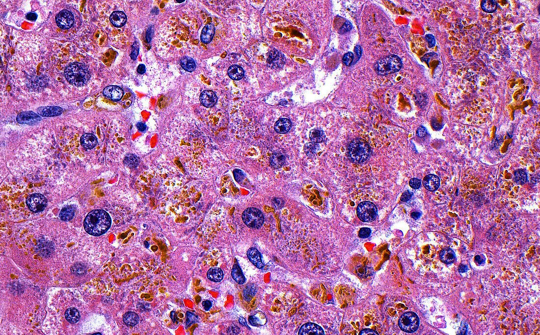 Liver cholestasis, light micrograph