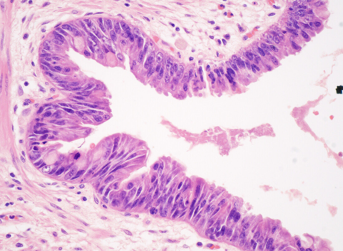 Gallbladder dysplasia, light micrograph
