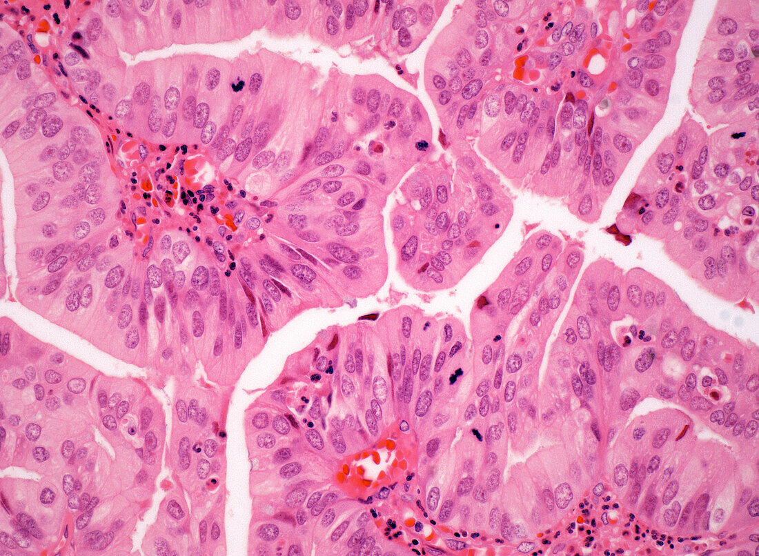 Intracholecystic papillary neoplasm, light micrograph