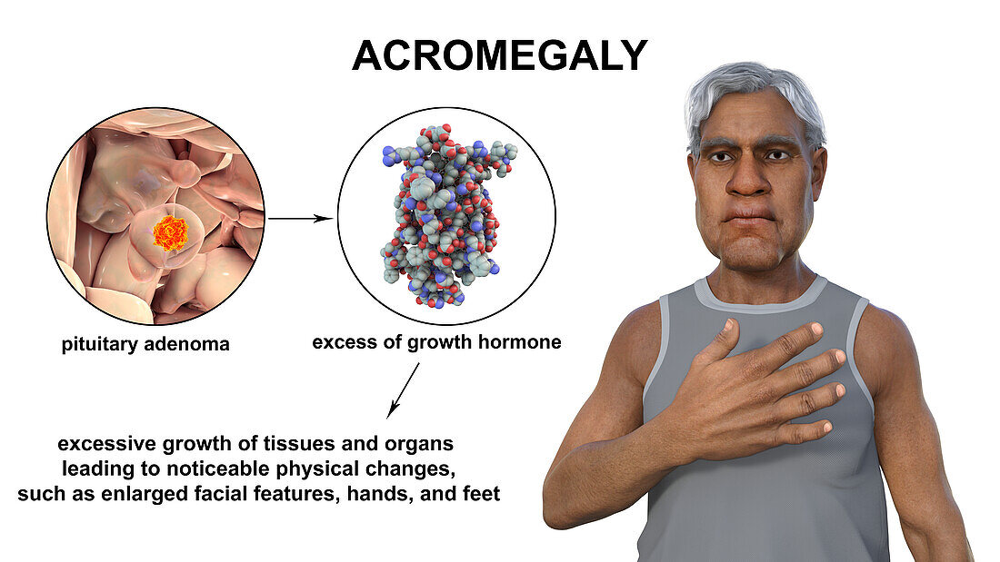 Acromegaly, illustration