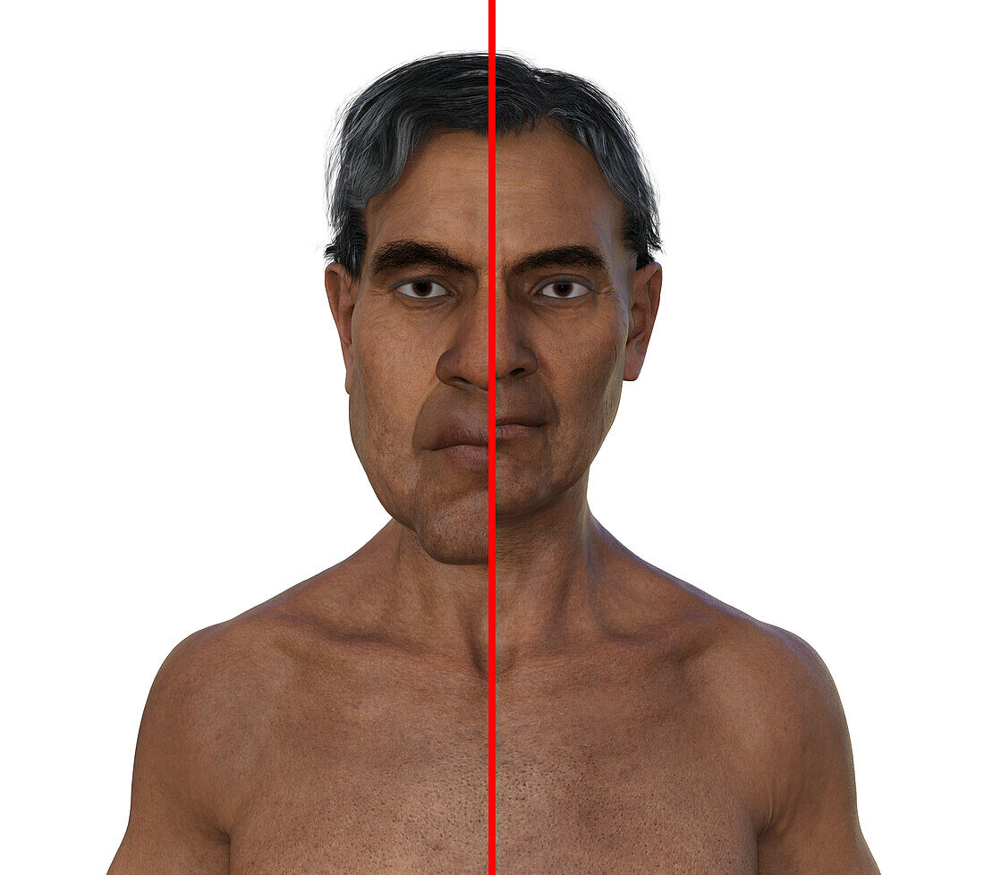 Acromegaly in a man compared to healthy man, illustration