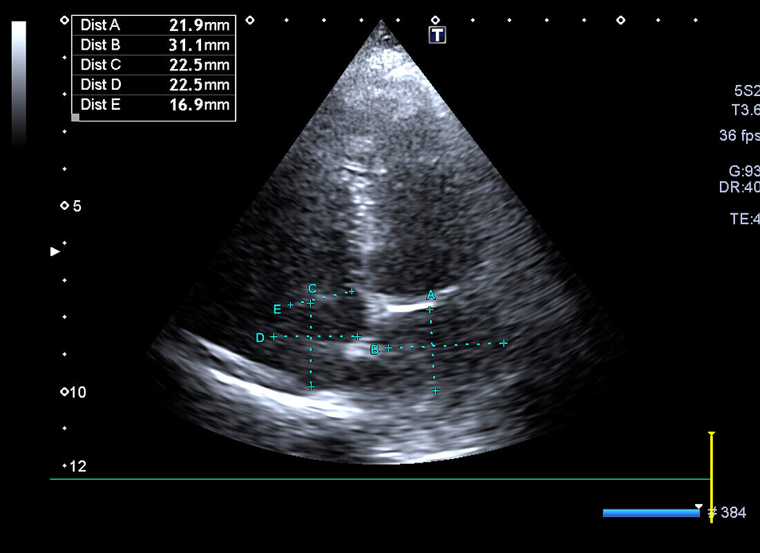 Atrial volume, ultrasound scan