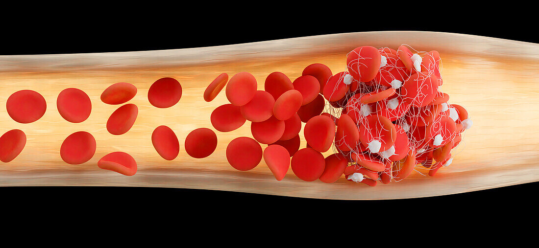 Blood clot, illustration