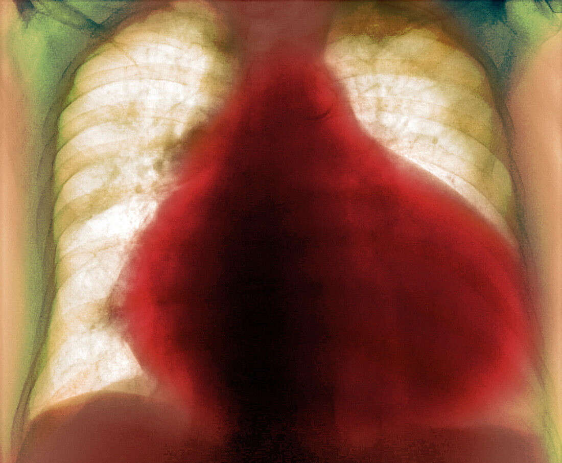 Enlarged heart, X-ray
