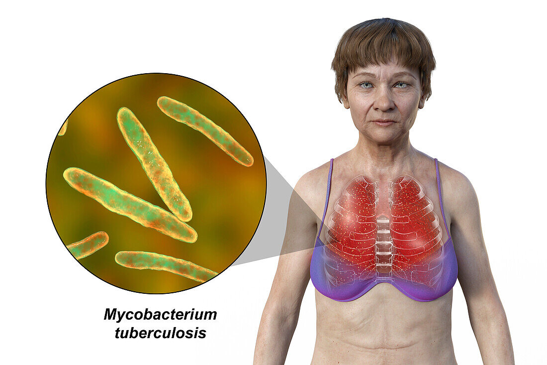 Woman with lung miliary tuberculosis, illustration