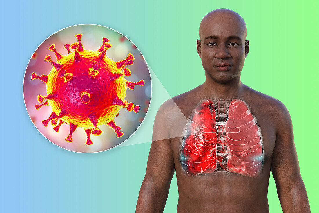 Man with lungs affected by Covid-19 pneumonia, illustration