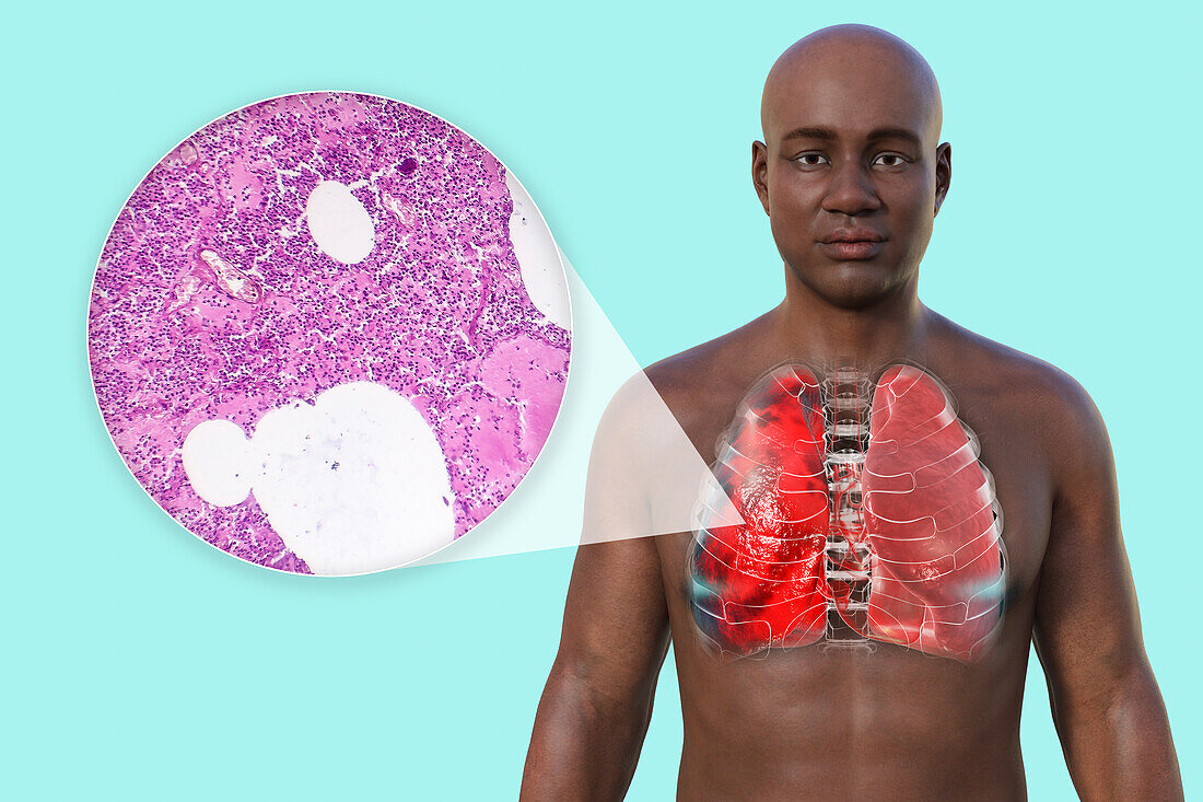 Man with lungs affected by pneumonia, illustration