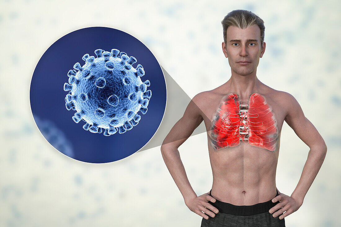 Man with lungs affected by Covid-19 pneumonia, illustration