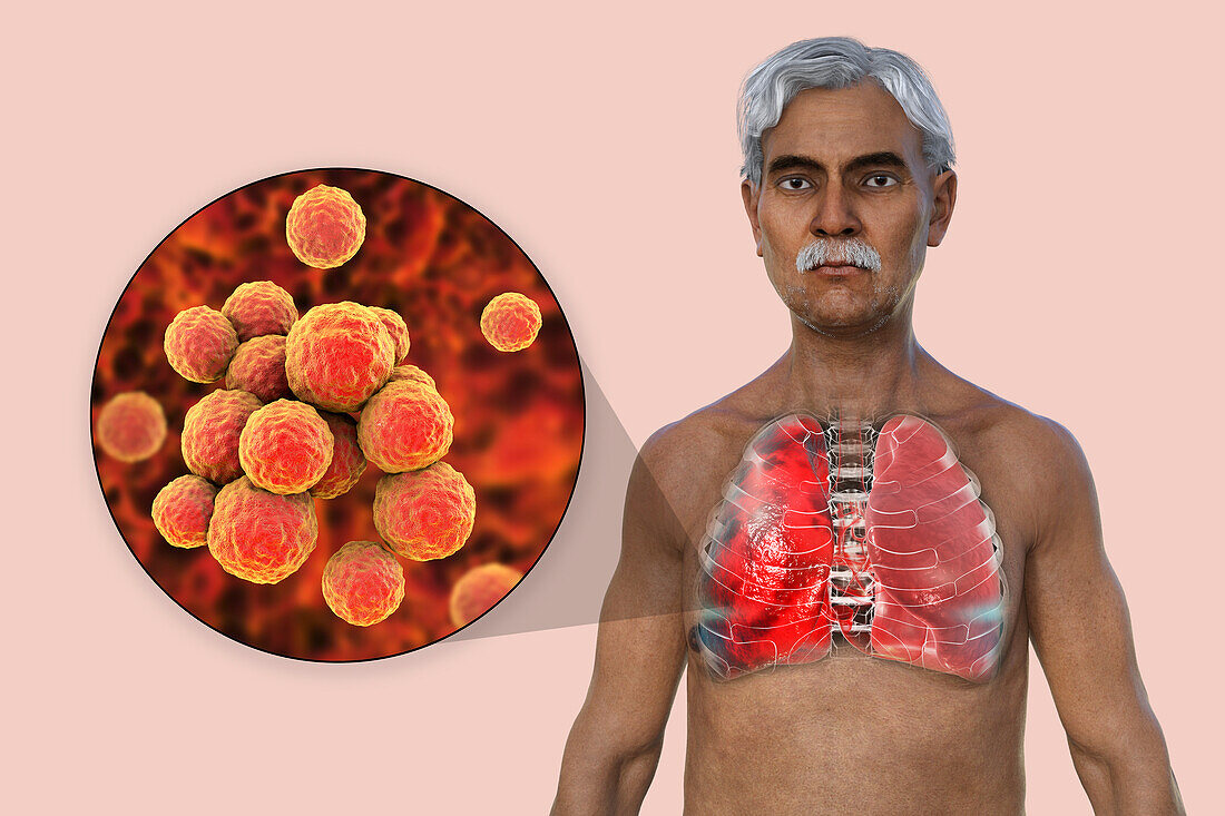 Man with lungs affected by pneumonia, illustration