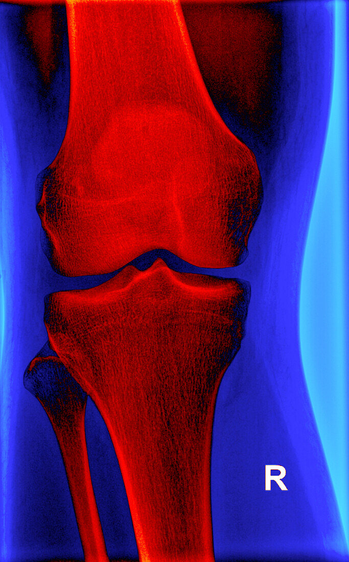 Right knee, X-ray