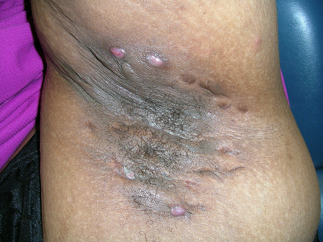 Hidradenitis suppurativa