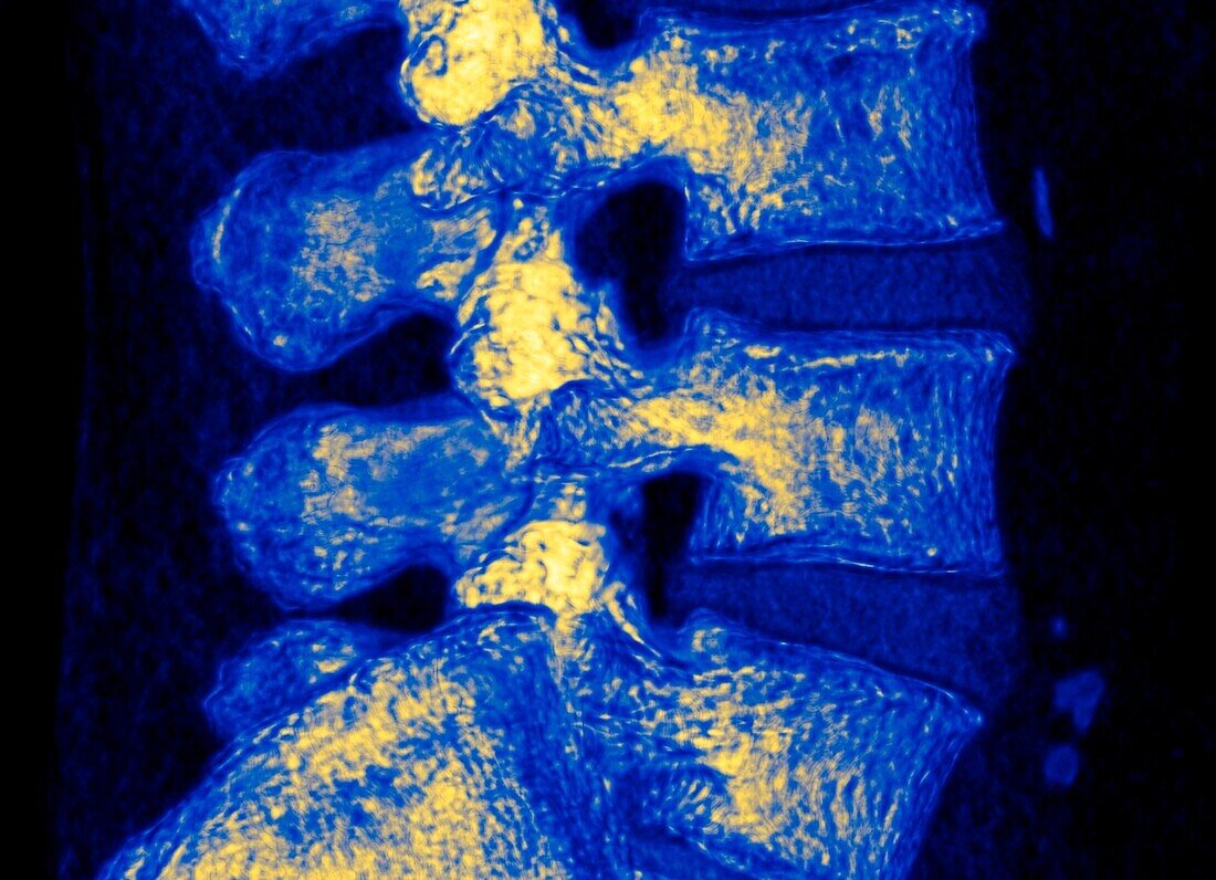 Lumbar spine, CT scan