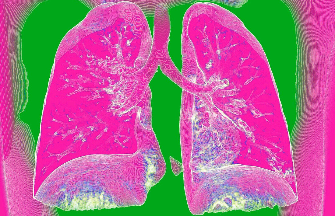Lungs, CT scan