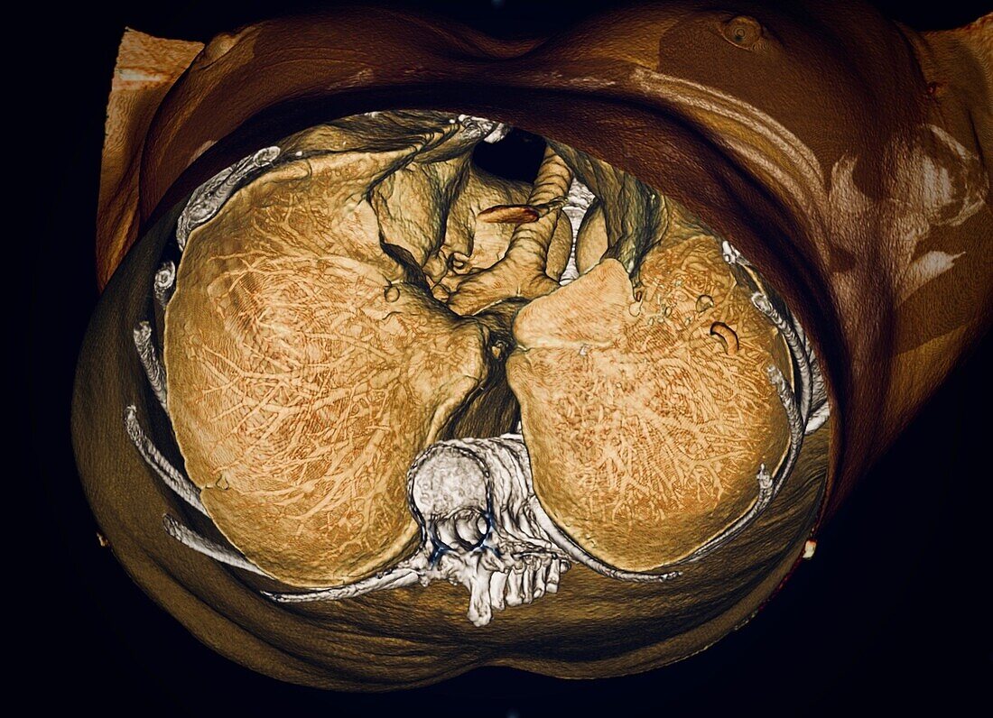 Lungs, CT scan