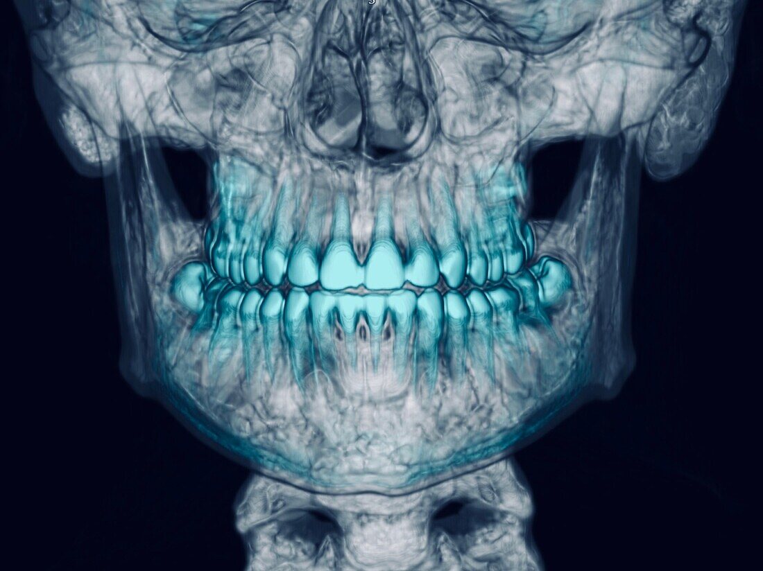 Jaw, CT scan
