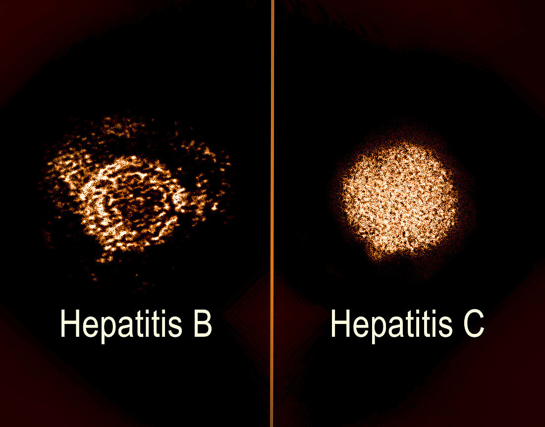 Hepatitis B and C, TEM micrographs