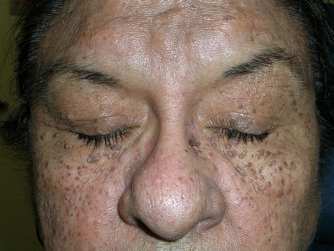 Dermatosis papulosa nigra