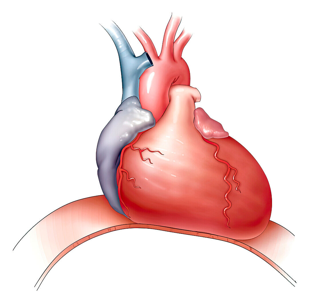 Cardiomegaly, illustration