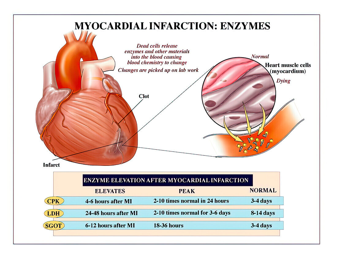 Heart enzymes during heart attack, illustration