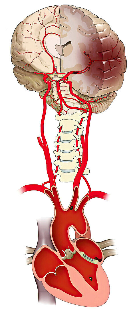 Embolic stroke following mitral valve replacement, illustration