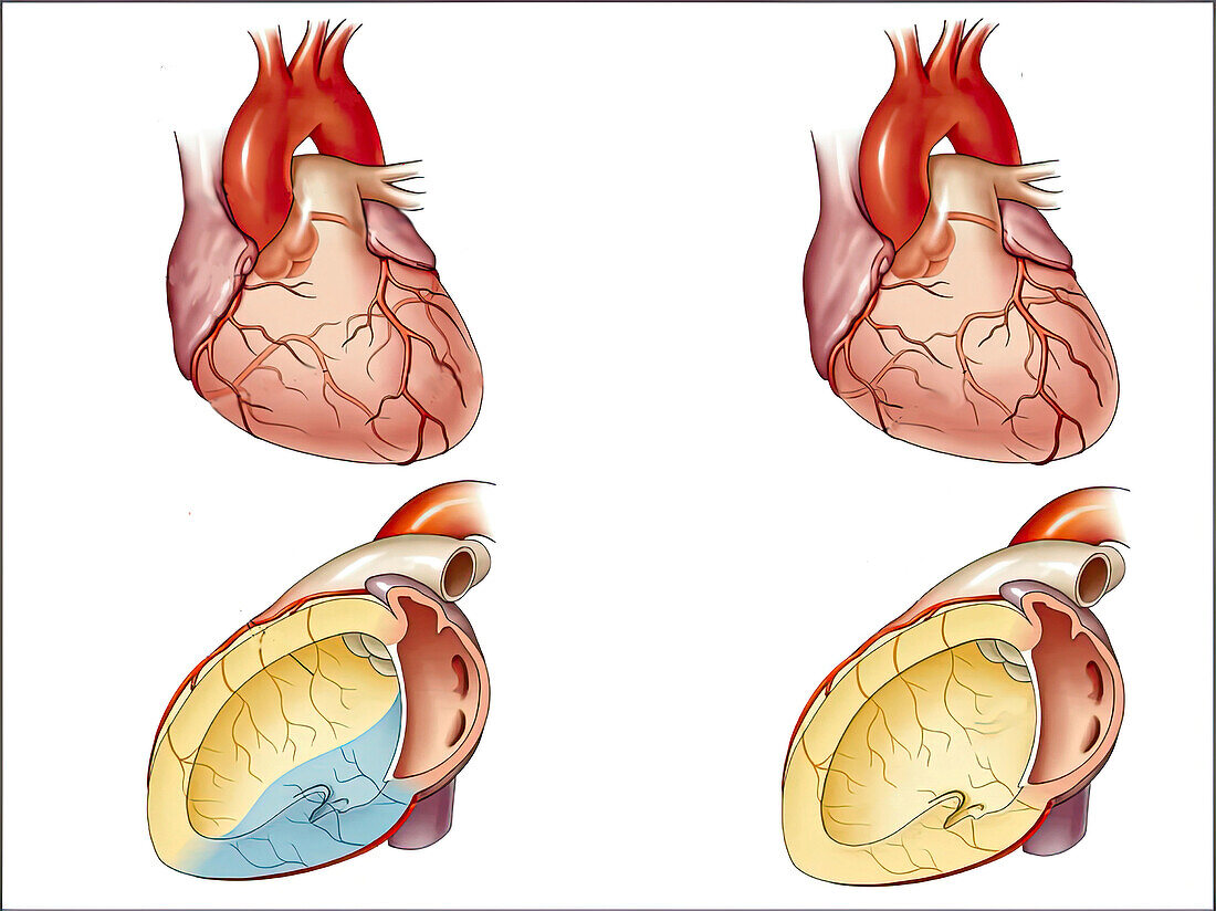 Blood supply to the left ventricle, illustration