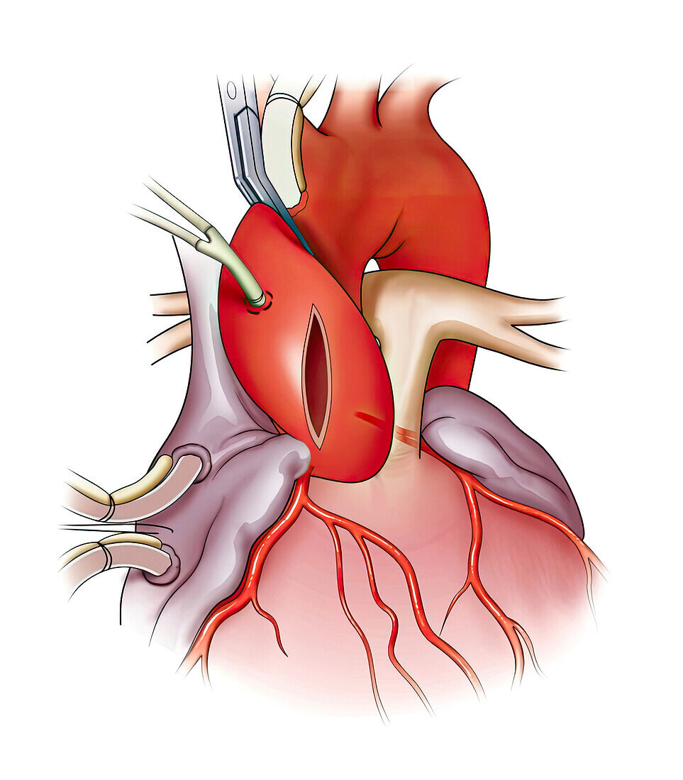 Valve surgery, illustration