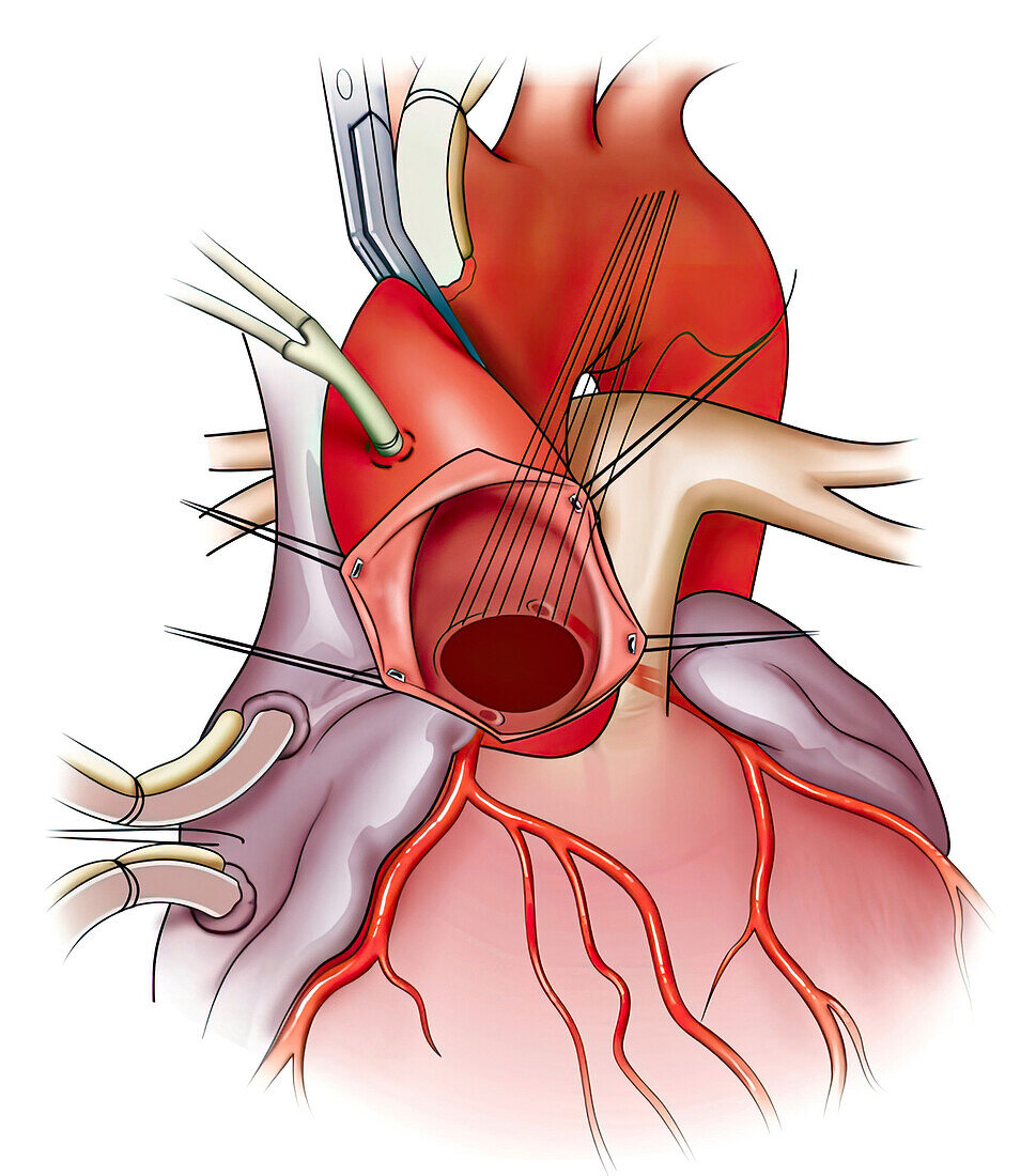 Valve surgery, illustration