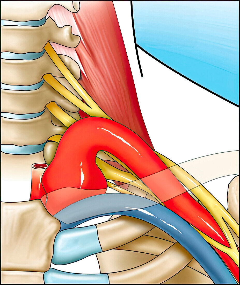 Aneurysm at base of left subclavian artery, illustration