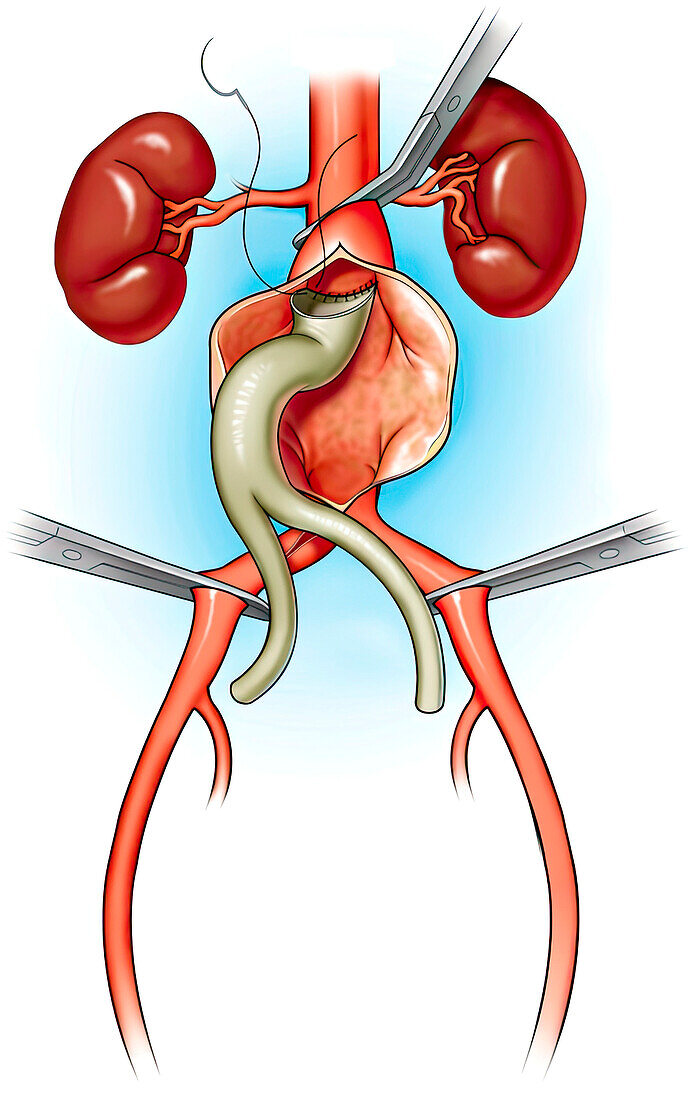 Graft placement for abdominal aortic aneurysm, illustration
