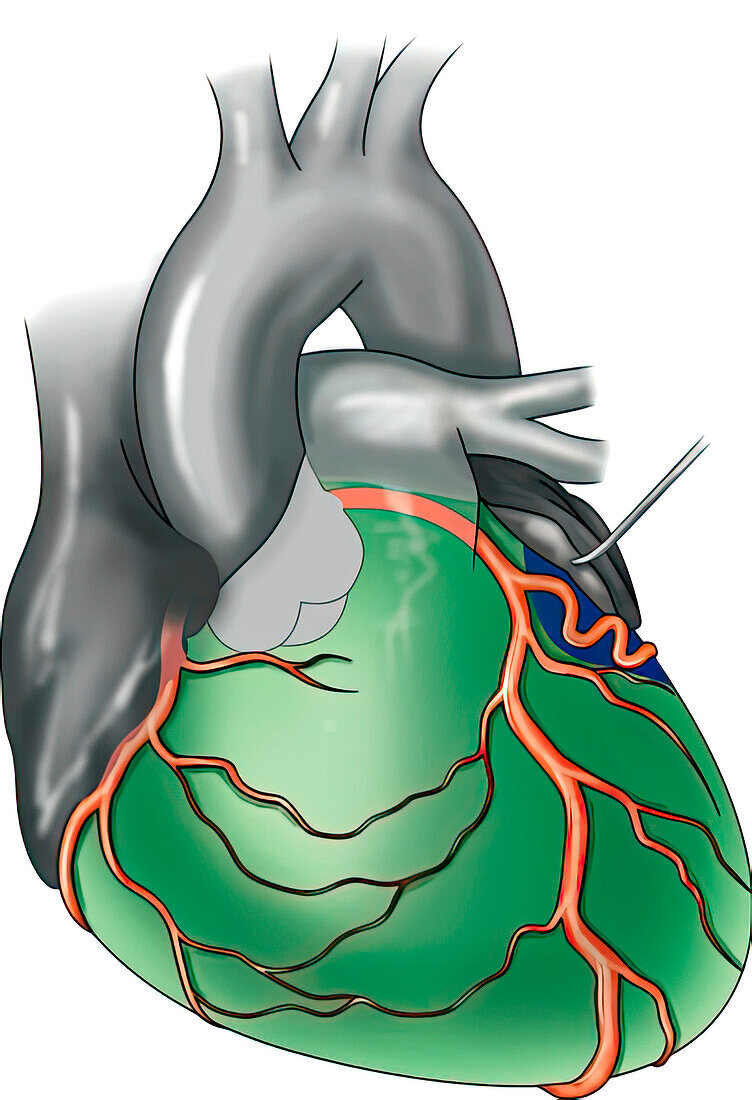 Heart showing area of infarction, illustration