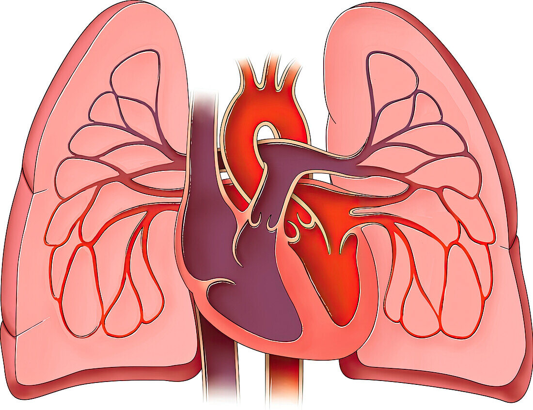 Pulmonary hypertension, illustration