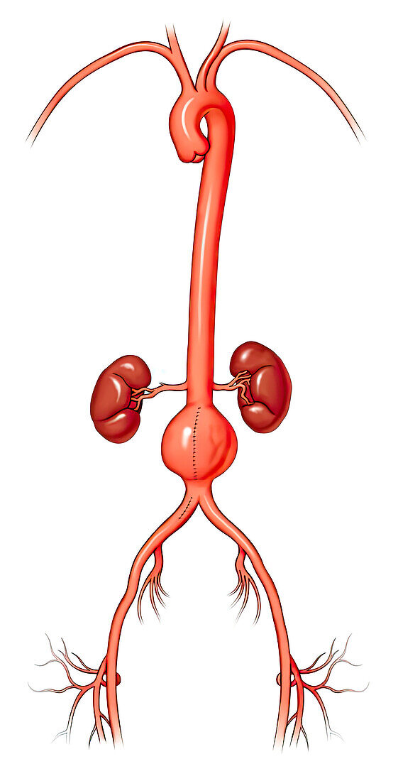 Abdominal aortic aneurysm, illustration