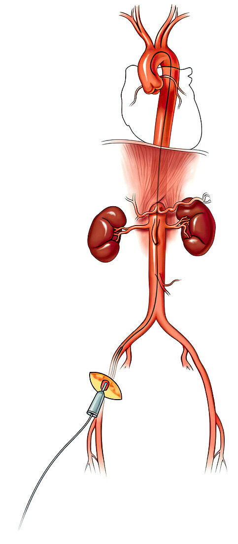 Coronary catheterization, illustration