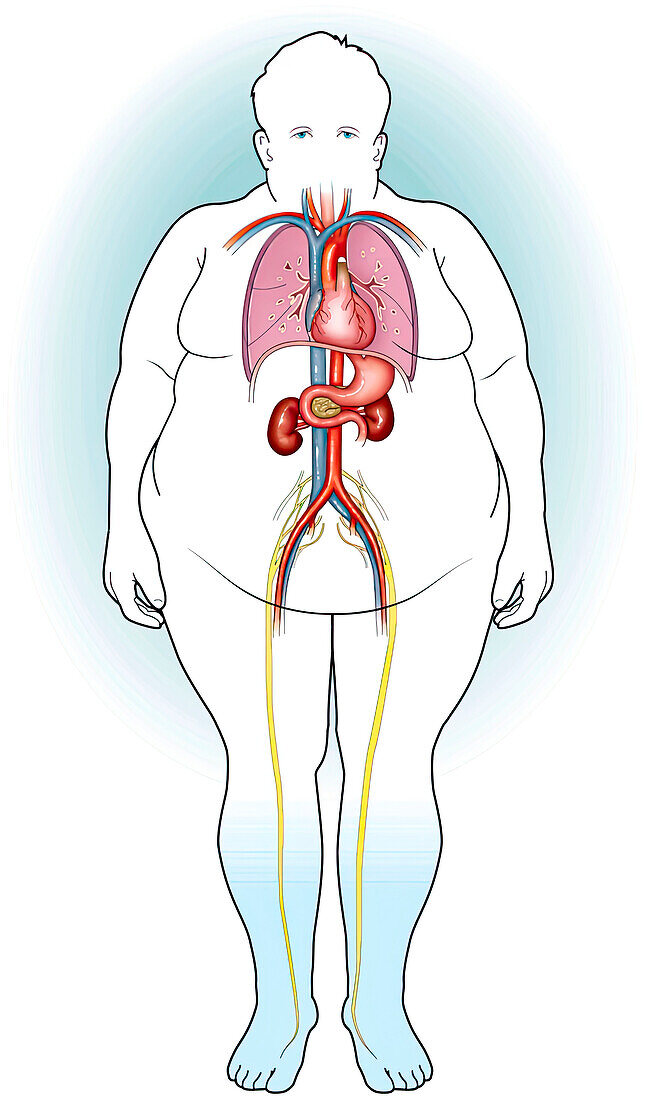 Peripheral vascular disease, illustration