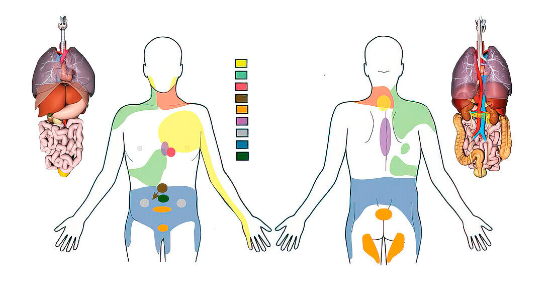 Referred pain, illustration