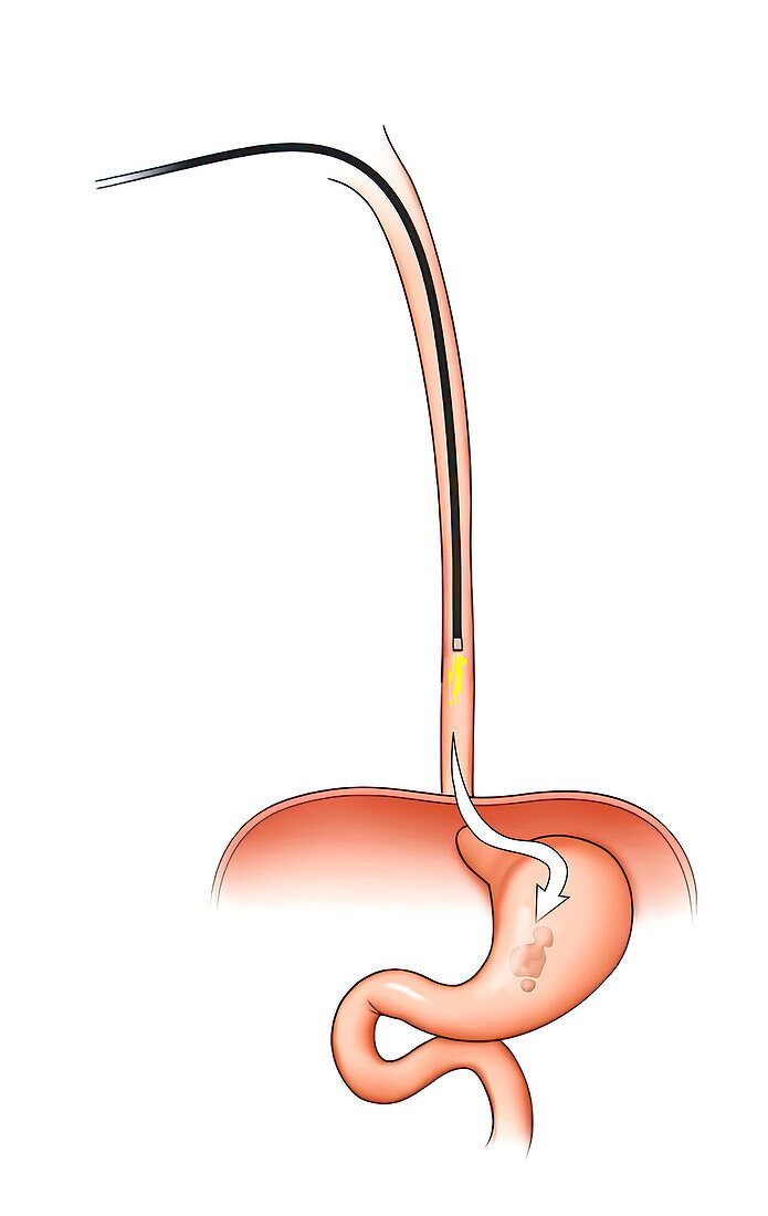 Gastroscopy, illustration