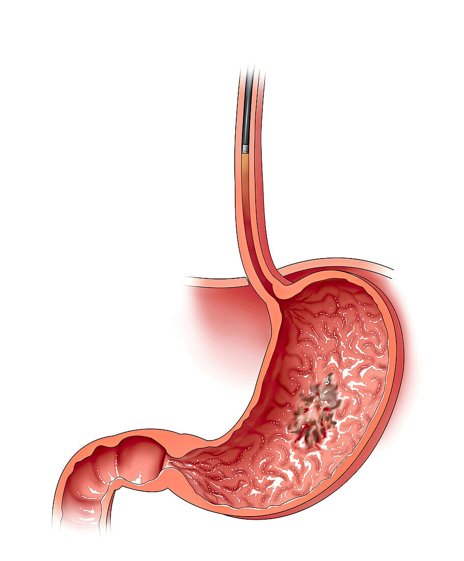 Stomach cancer with esophagoscope, illustration