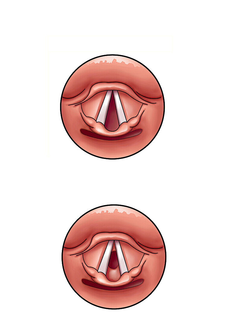 Subglottic stenosis, illustration