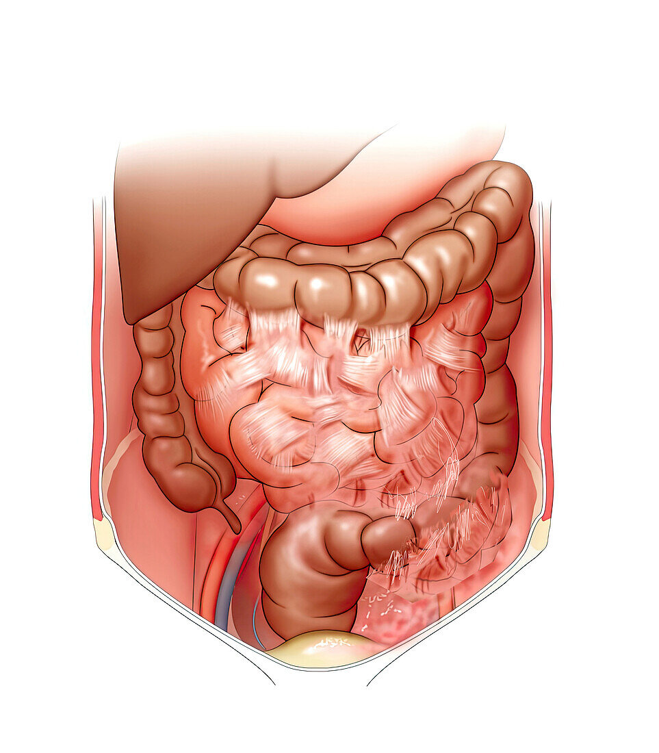 Severe adhesions from malignant tumour, illustration