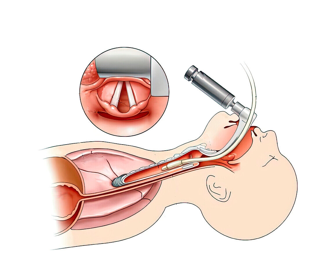 Endotracheal intubation, illustration