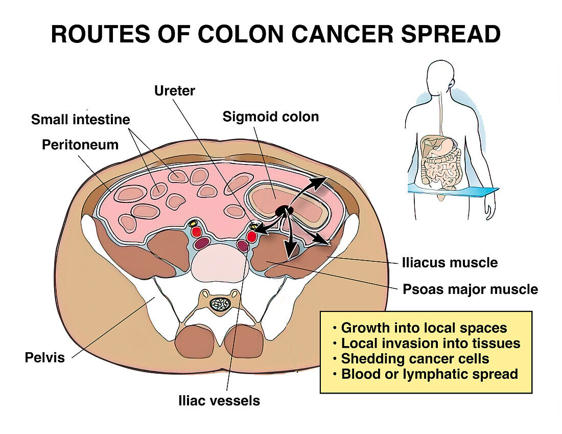 Colon cancer spread, illustration