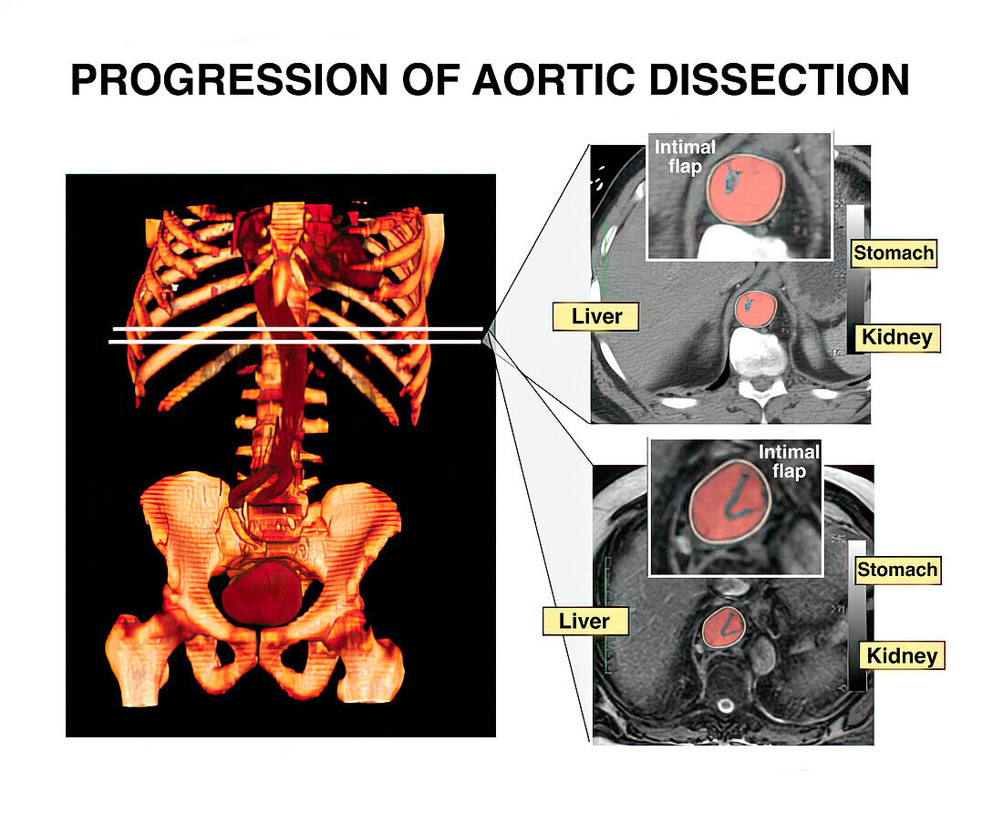 Progression of aortic dissection, illustration
