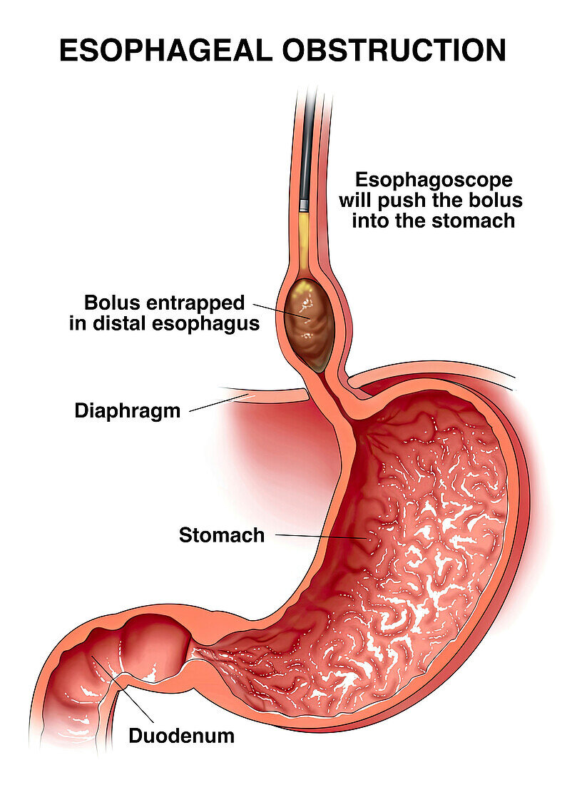 Oesophageal obstruction, illustration