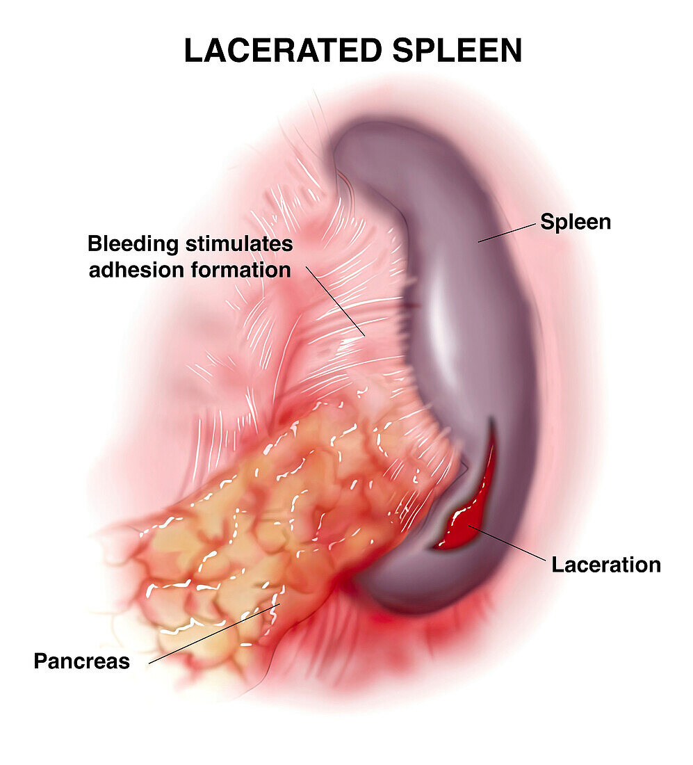 Lacerated spleen, illustration
