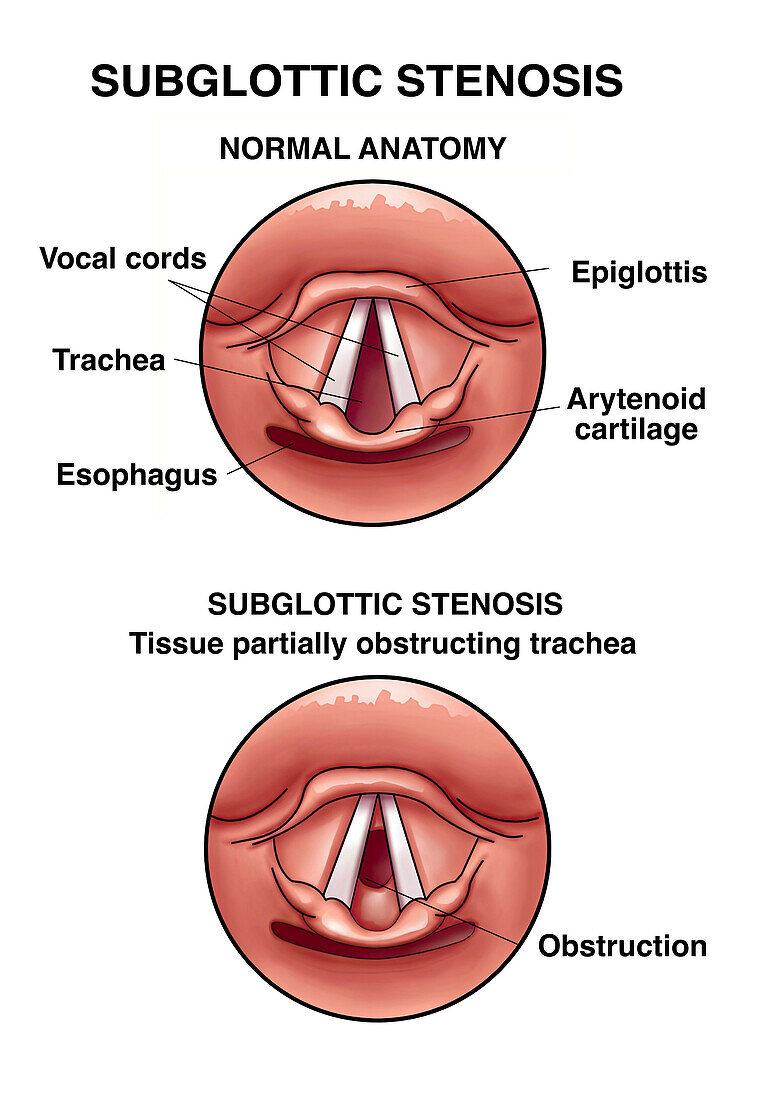 Subglottic stenosis, illustration