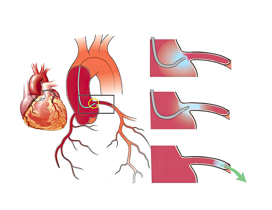 Cardiac catheterization, illustration