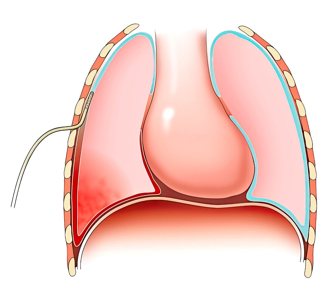 Lung contusion with haemothorax, illustration