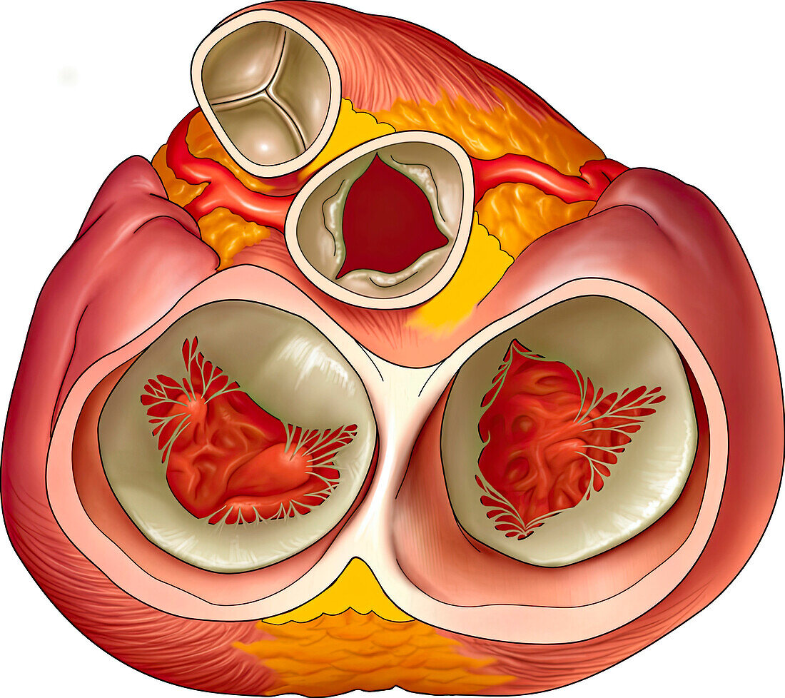 Aortic valve incompetence, illustration