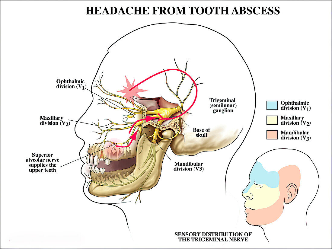 Tooth abscess results in headache, illustration
