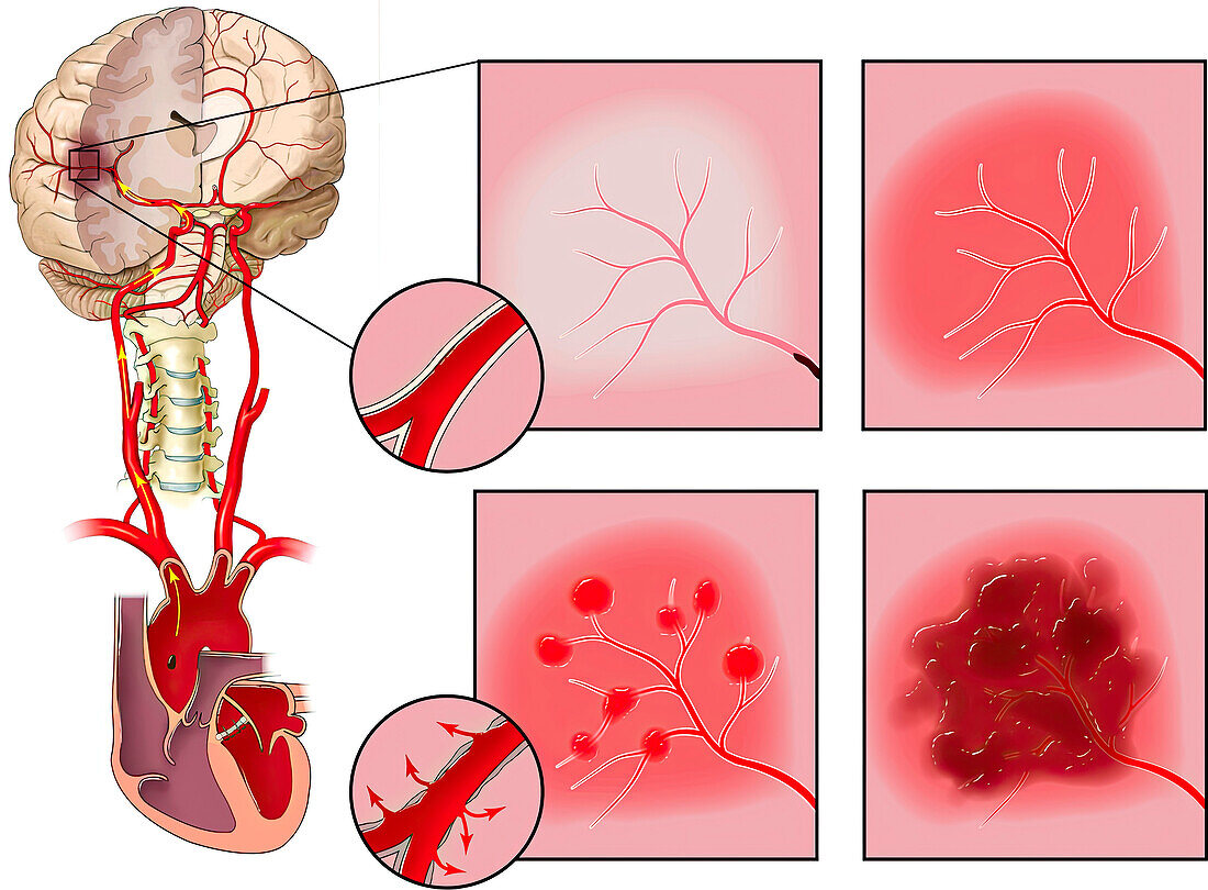 Progression of embolic stroke, illustration